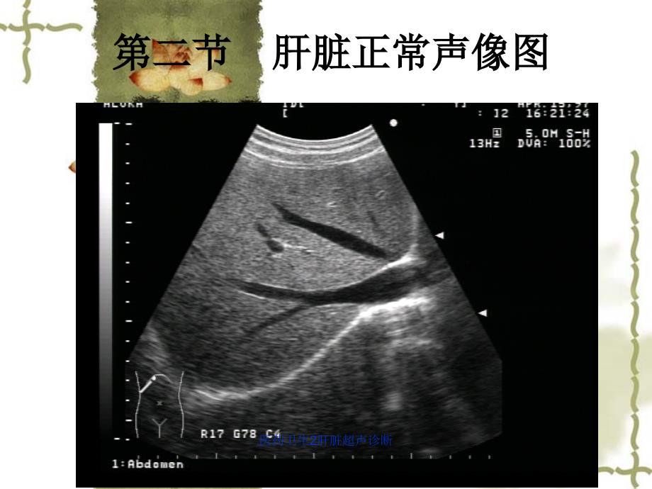 医药卫生2肝脏超声诊断课件_第5页