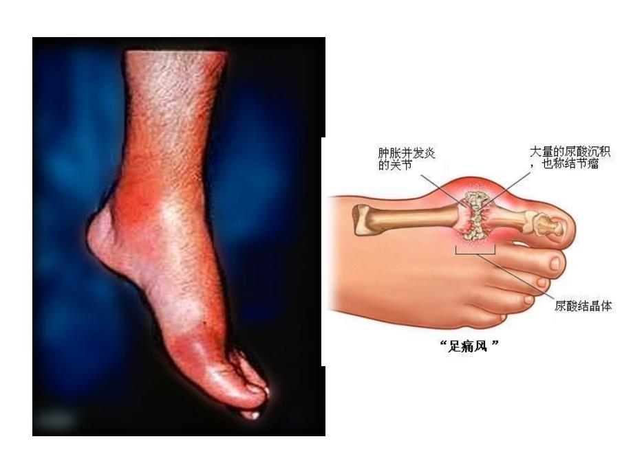 痛风病人的饮食指导_第3页