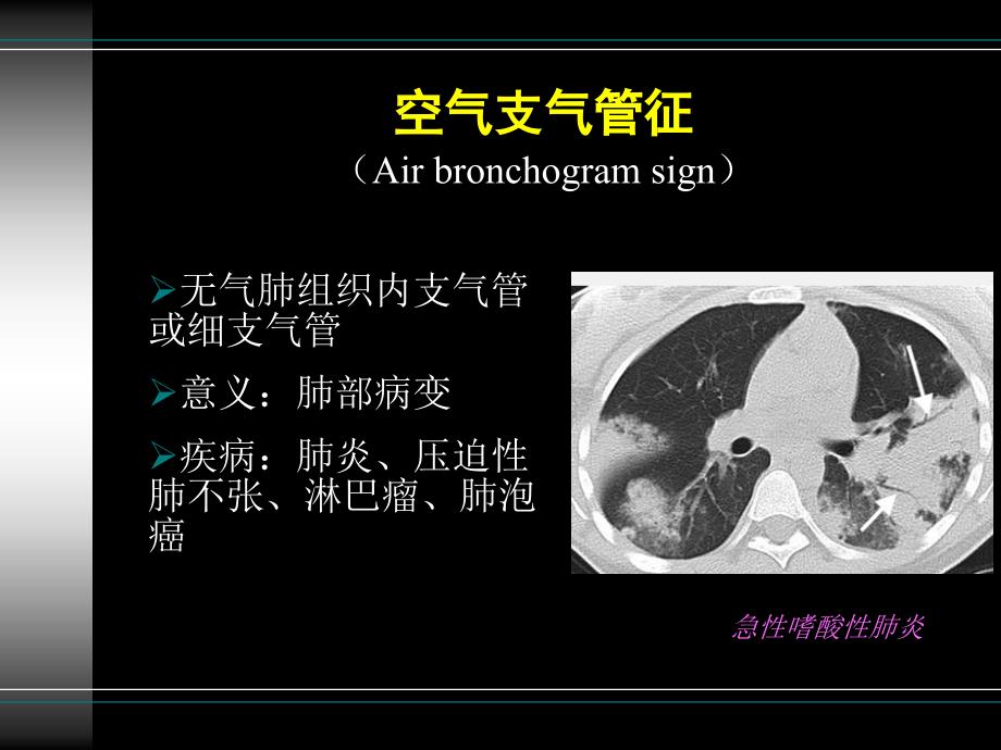 胸部疾病常见影像学征象_第3页