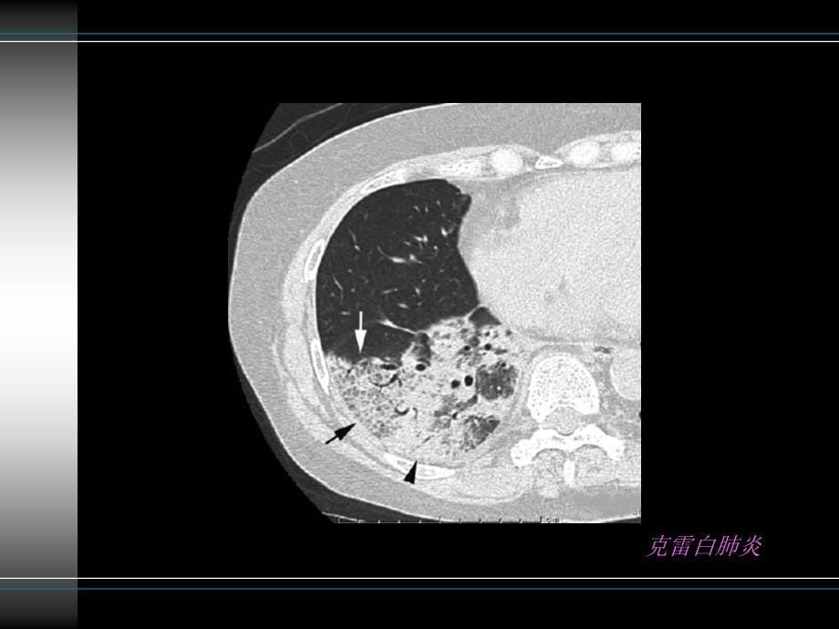 胸部疾病常见影像学征象_第5页