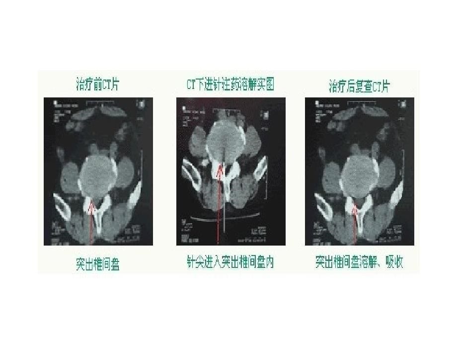 脊柱微创手术简介课件_第5页