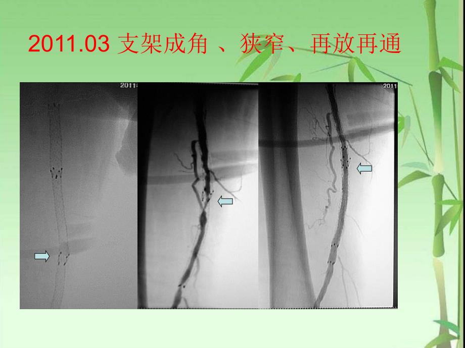 介入十年回眸外周动脉篇之4支架断裂浅析_第4页