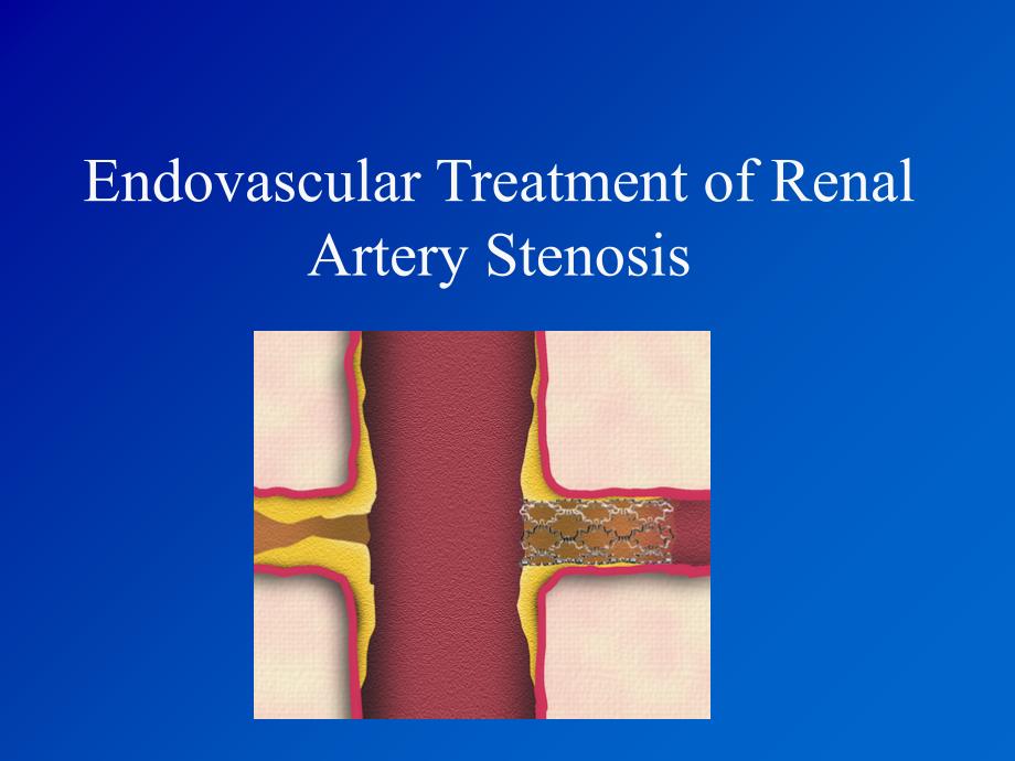 肾动脉支架植入术图文详解ppt课件_第1页