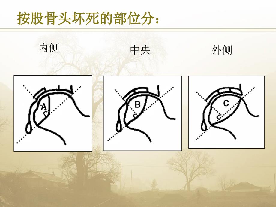 股骨头坏死(ARCO分期)围塌陷期_第2页