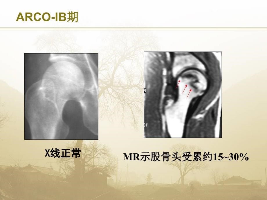 股骨头坏死(ARCO分期)围塌陷期_第5页