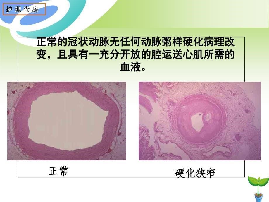 《冠状动脉搭桥术》PPT课件_第5页