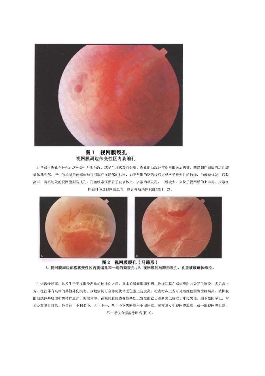 视网膜脱落及视网膜脱落手术后注意事项_第5页