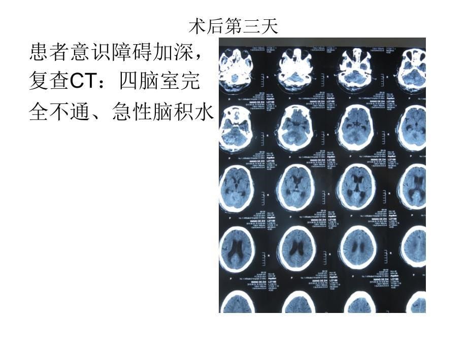 幕下术后发生急性梗阻性脑积水的思考与处理_第5页