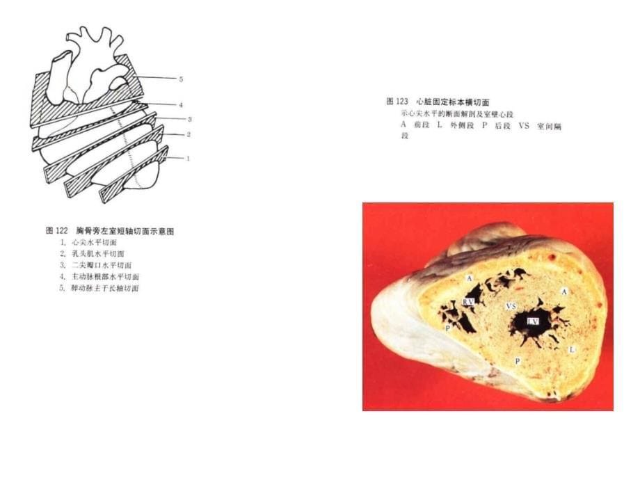 心脏断面解剖及室壁心段_第5页