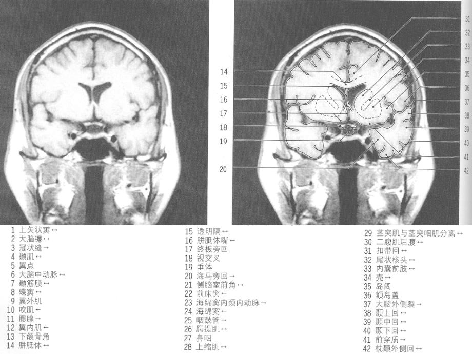 MRI颅脑冠状位解剖图谱(2)资料课件_第1页