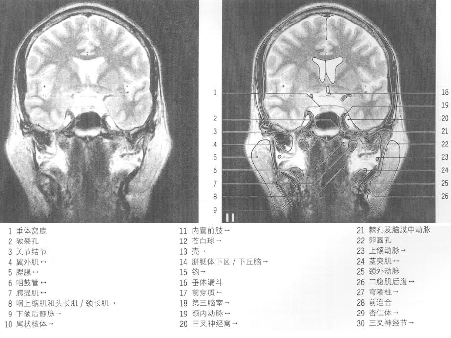 MRI颅脑冠状位解剖图谱(2)资料课件_第2页