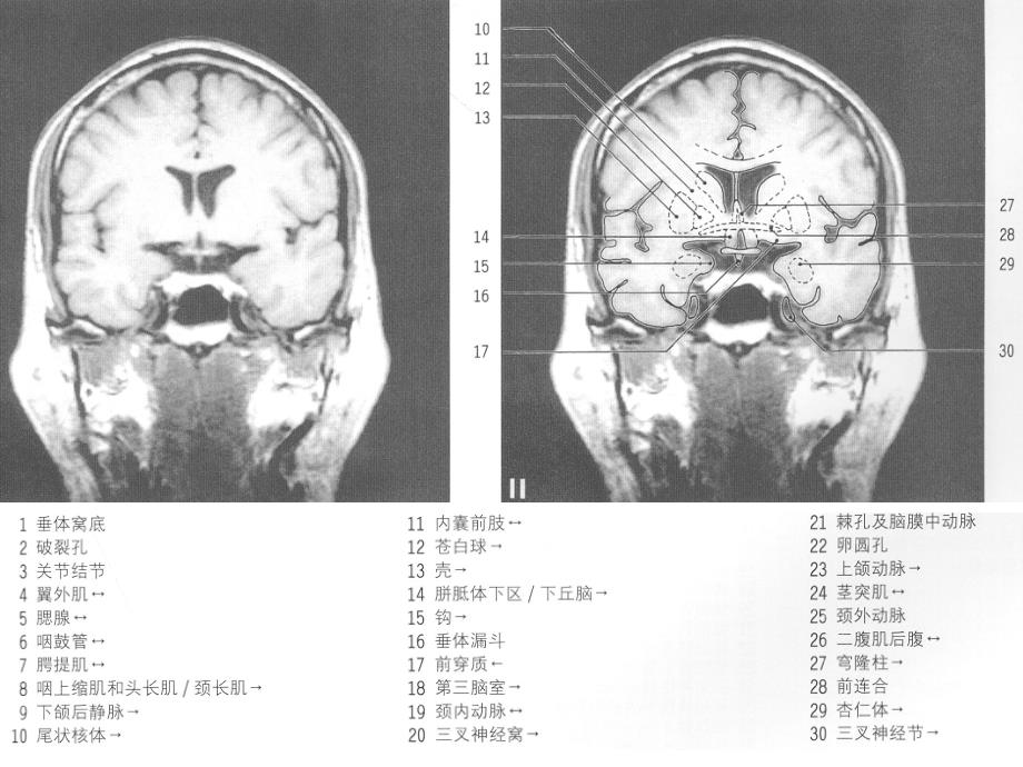 MRI颅脑冠状位解剖图谱(2)资料课件_第3页