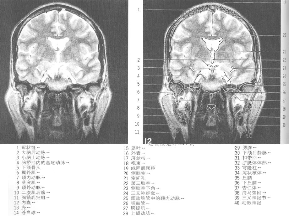 MRI颅脑冠状位解剖图谱(2)资料课件_第4页