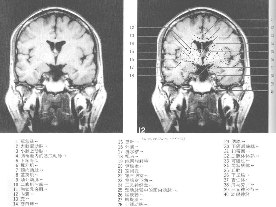 MRI颅脑冠状位解剖图谱(2)资料课件_第5页