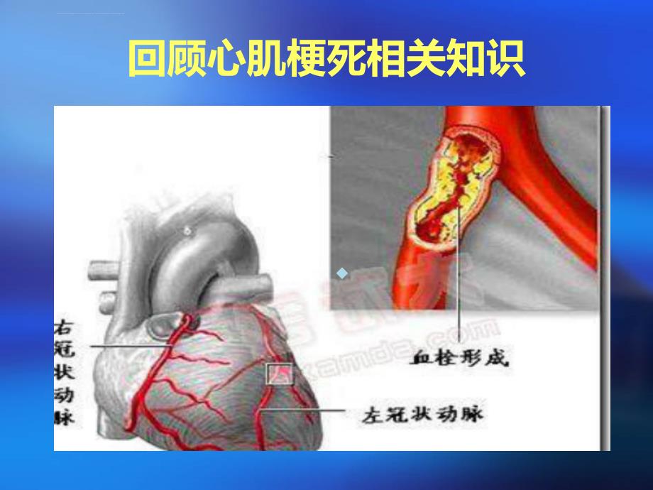 心肌梗塞护理查房ppt课件2_第2页