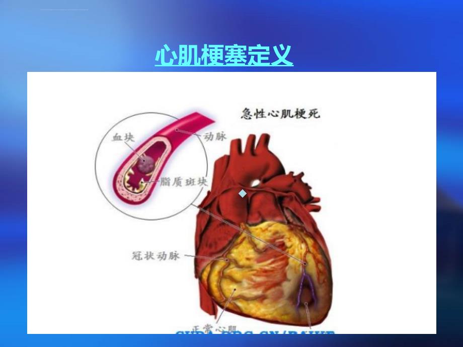 心肌梗塞护理查房ppt课件2_第3页