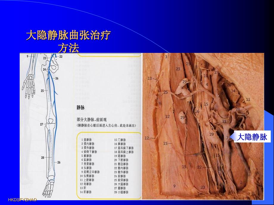 大隐静脉曲张治疗方法课件_第3页