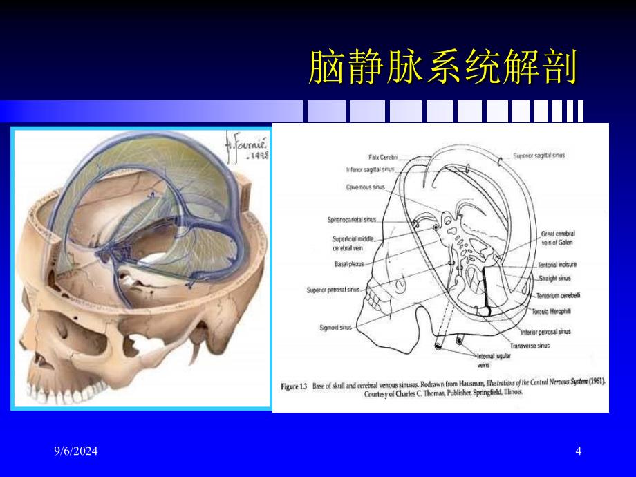 脑静脉和静脉窦血栓形成新进展_第4页