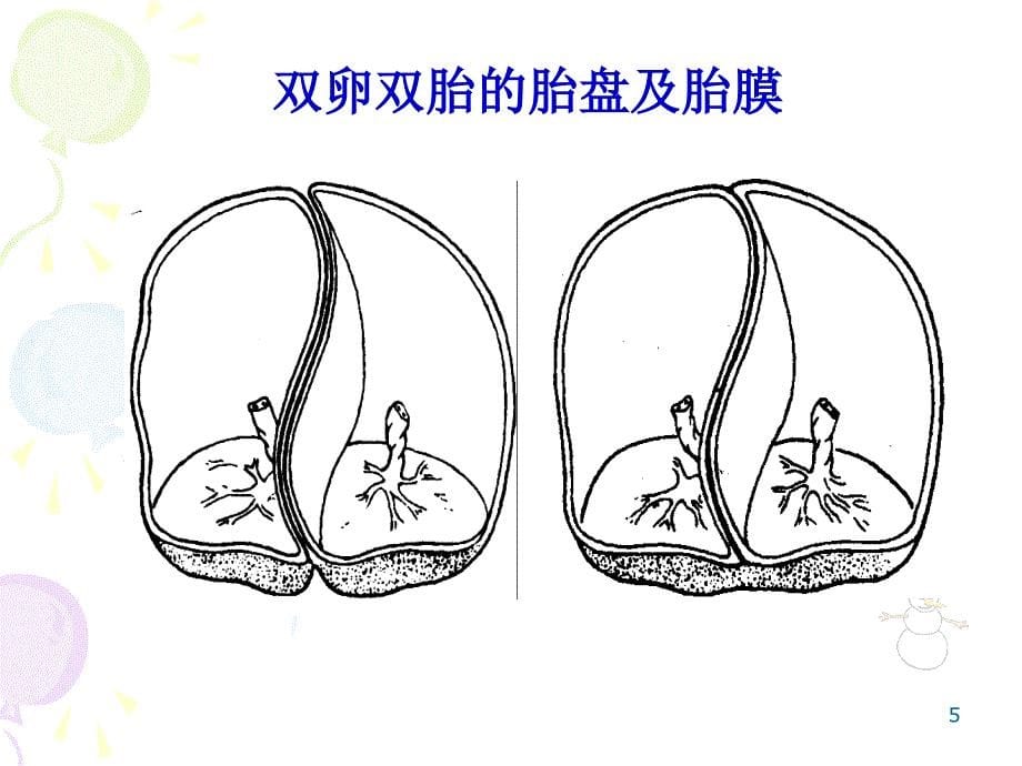 多胎妊娠与巨大胎儿教学课件幻灯PPT_第5页