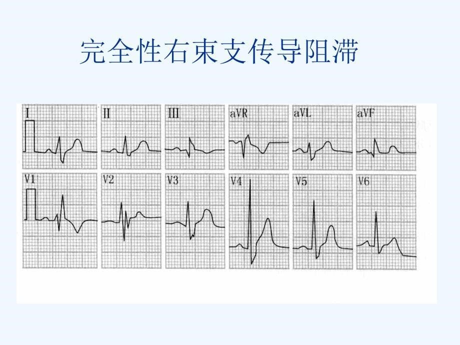 心电图室内差异性传导阻滞课件_第5页