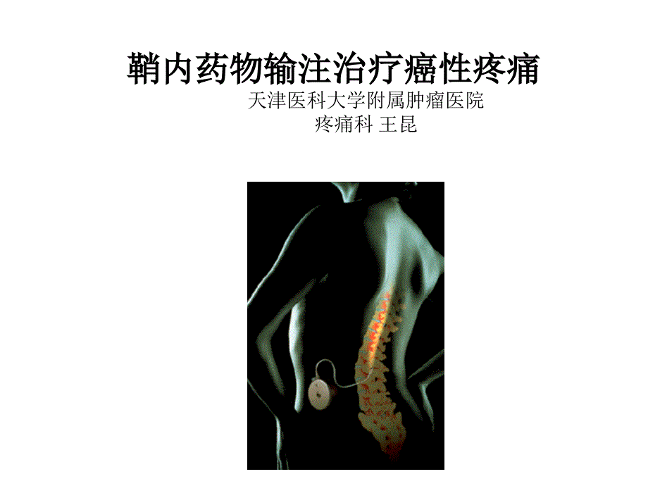 鞘内药物输注治疗癌性疼痛(王昆)_第1页