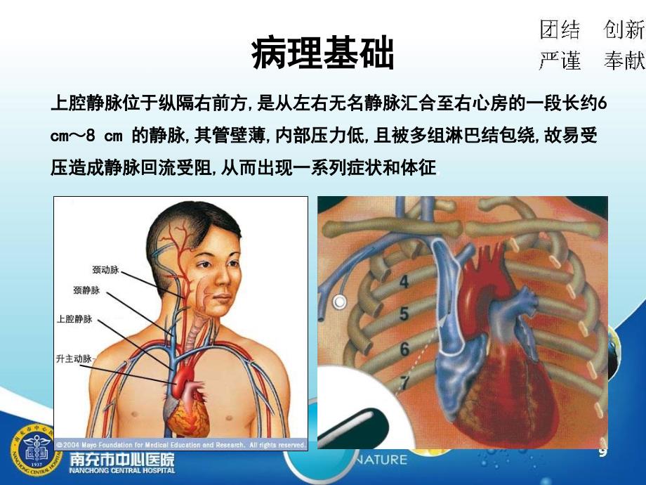 上腔静脉综合征护理查房文档资料_第2页