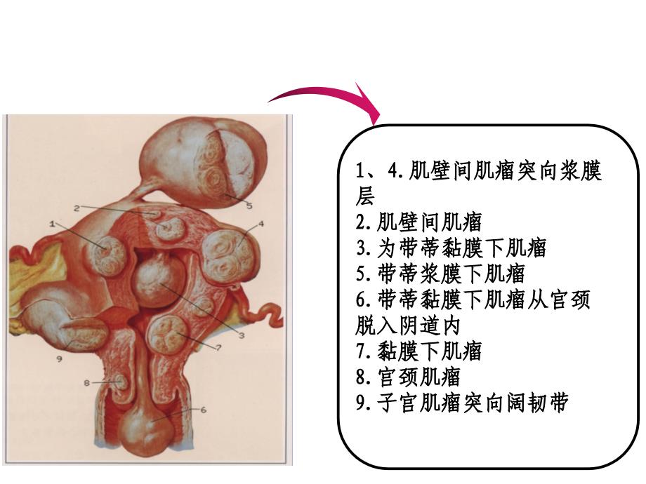 子宫动脉栓塞术的护理2021优秀课件_第4页