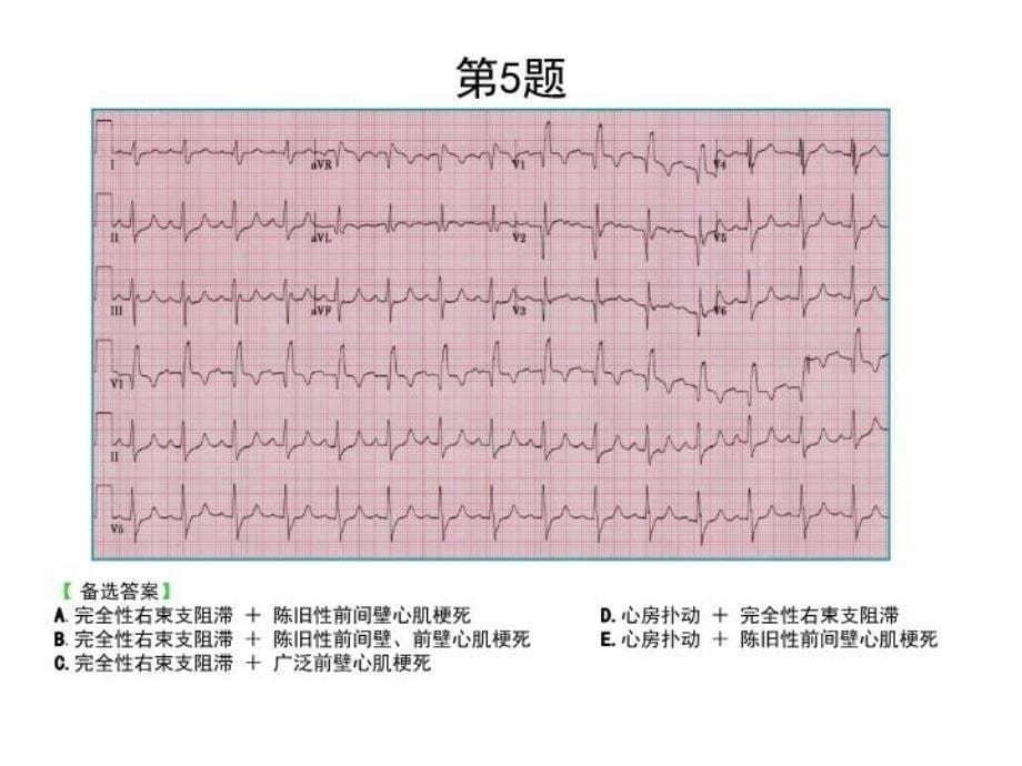 最新心电图考核题ppt课件PPT课件_第5页