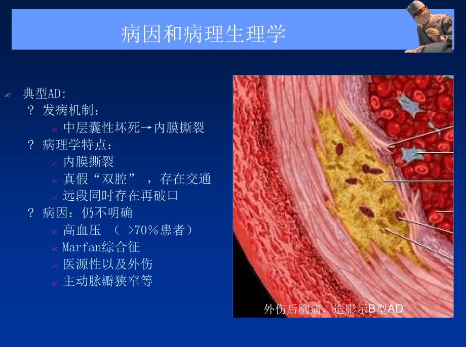 主动脉夹层壁间血肿及穿通性溃疡_第4页