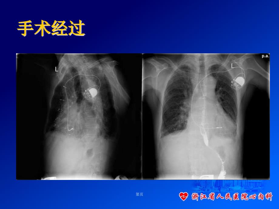 三尖瓣生物瓣置换术后右室心内膜起搏_第5页