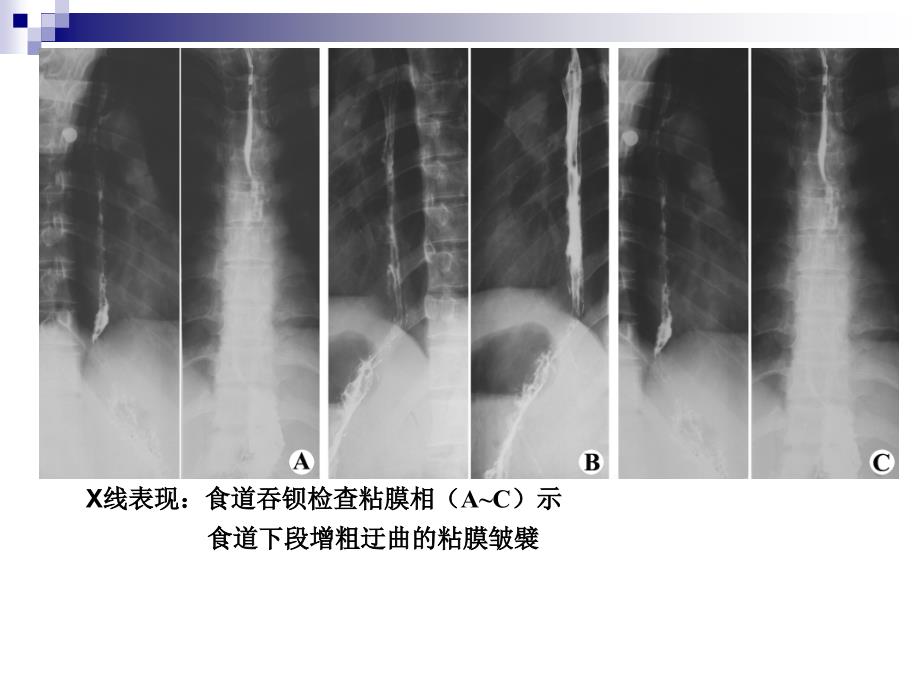 胃肠道常见病影像诊断_第4页