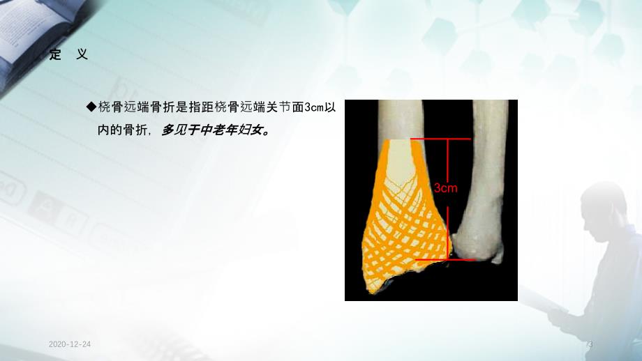 桡骨远端骨折的护理查房实用课件_第3页