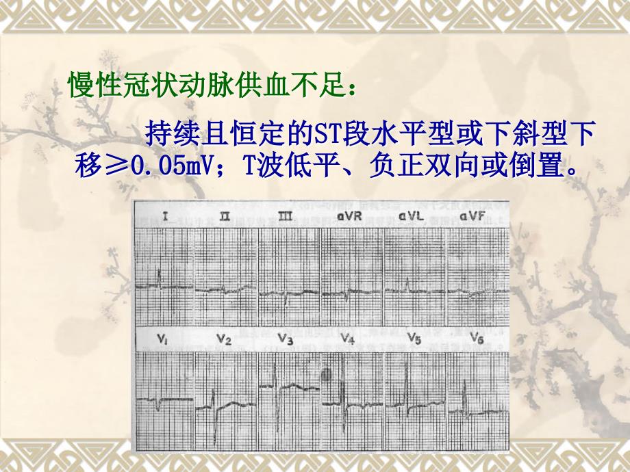 心肌缺血心电图课件.ppt_第4页