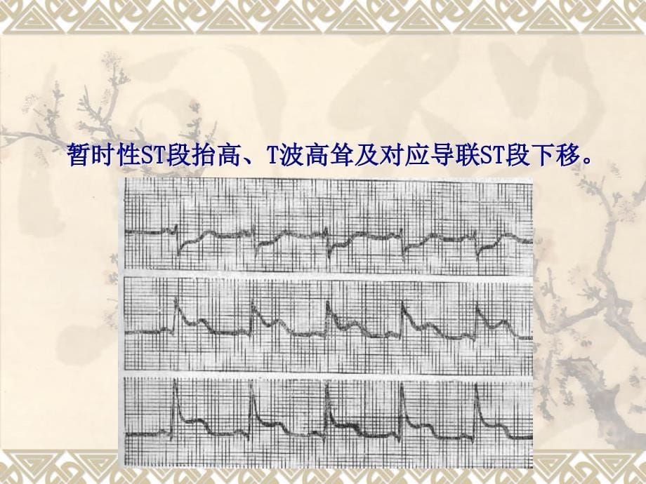 心肌缺血心电图课件.ppt_第5页