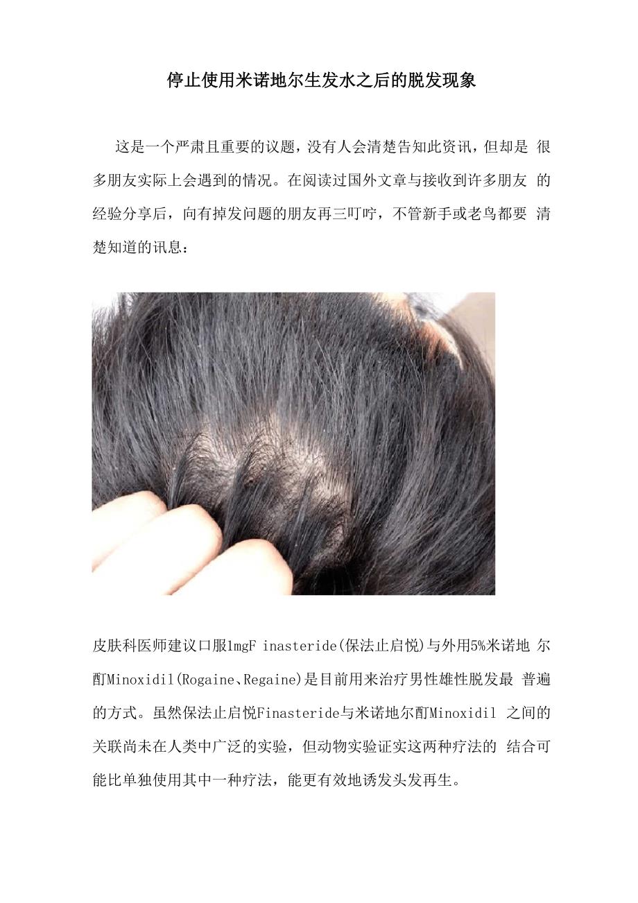 停止使用米诺地尔生发水_第1页