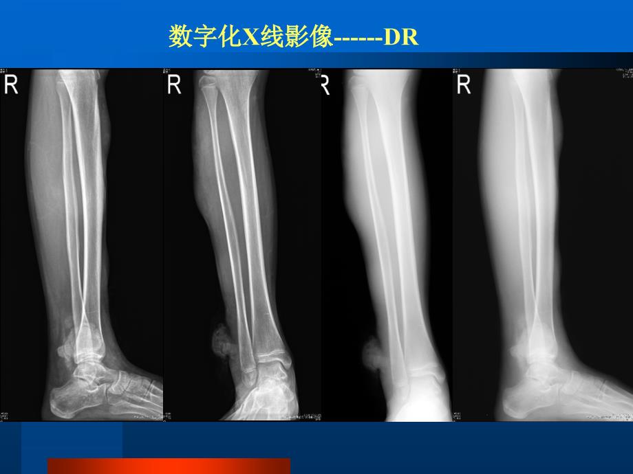 医学影像学课件：骨骼和肌肉系统影像诊断_第5页