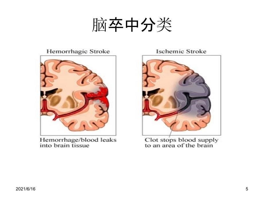 脑卒中的症状和定位_第5页