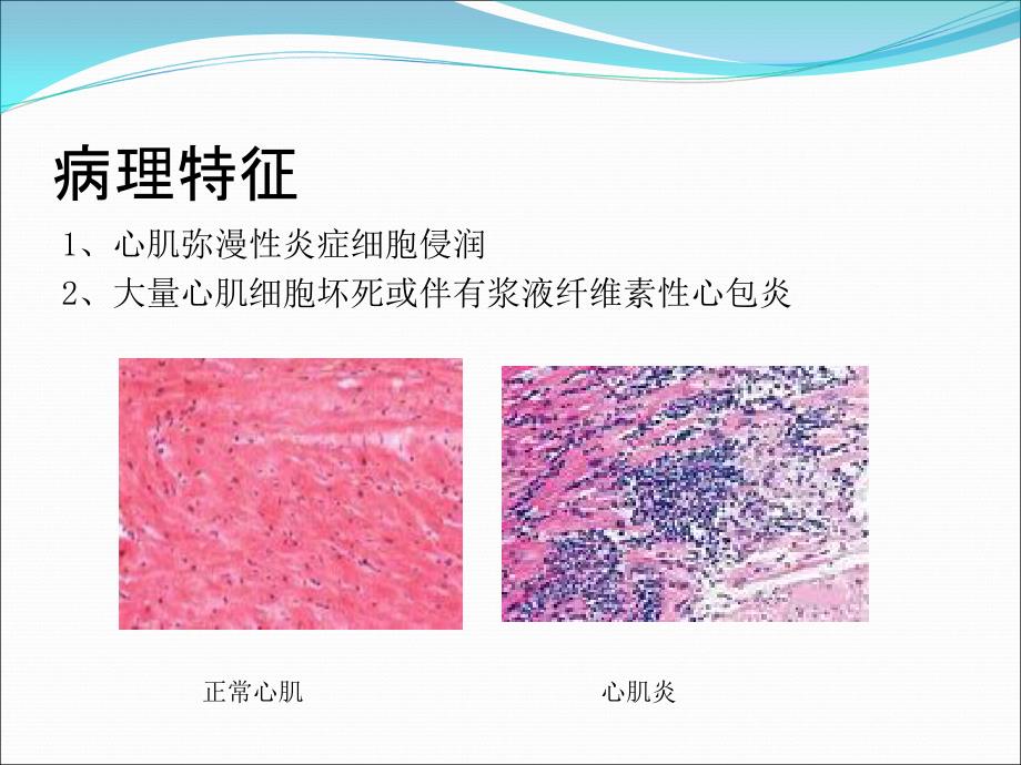 暴发性心肌炎ppt56285_第4页