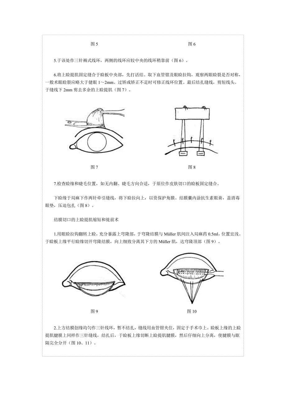 上睑提肌缩短和徙前术.doc_第3页