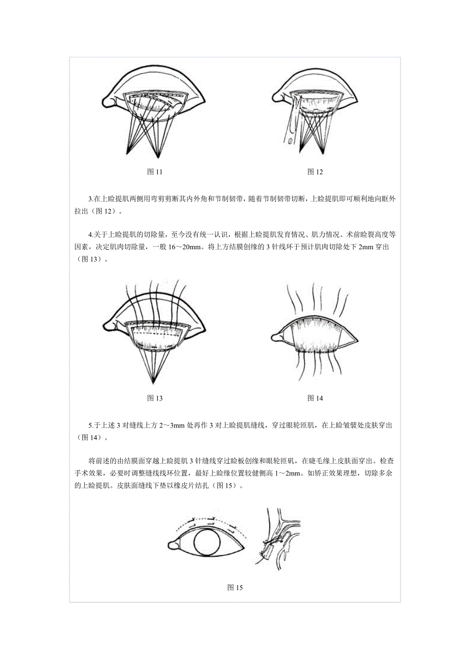 上睑提肌缩短和徙前术.doc_第4页