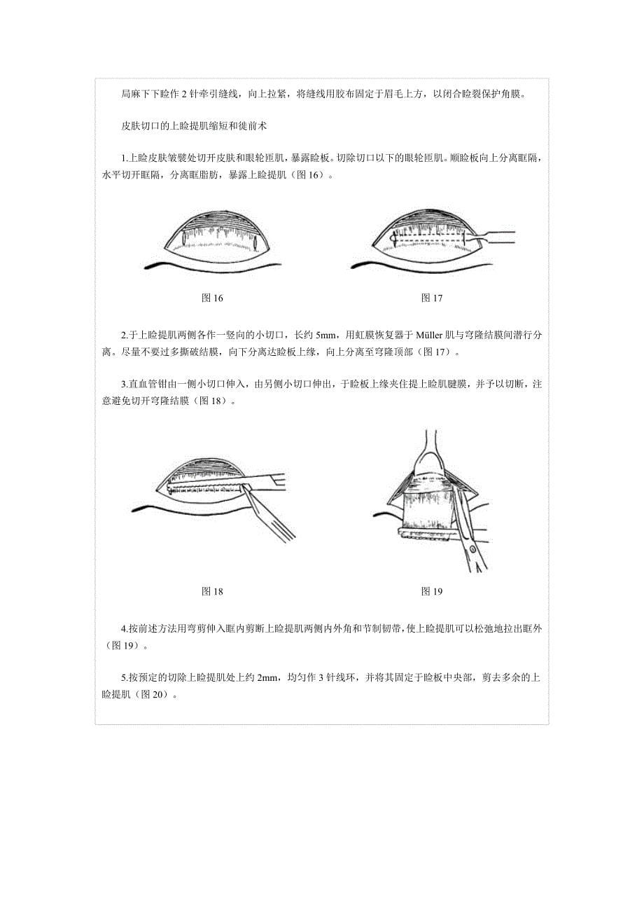 上睑提肌缩短和徙前术.doc_第5页