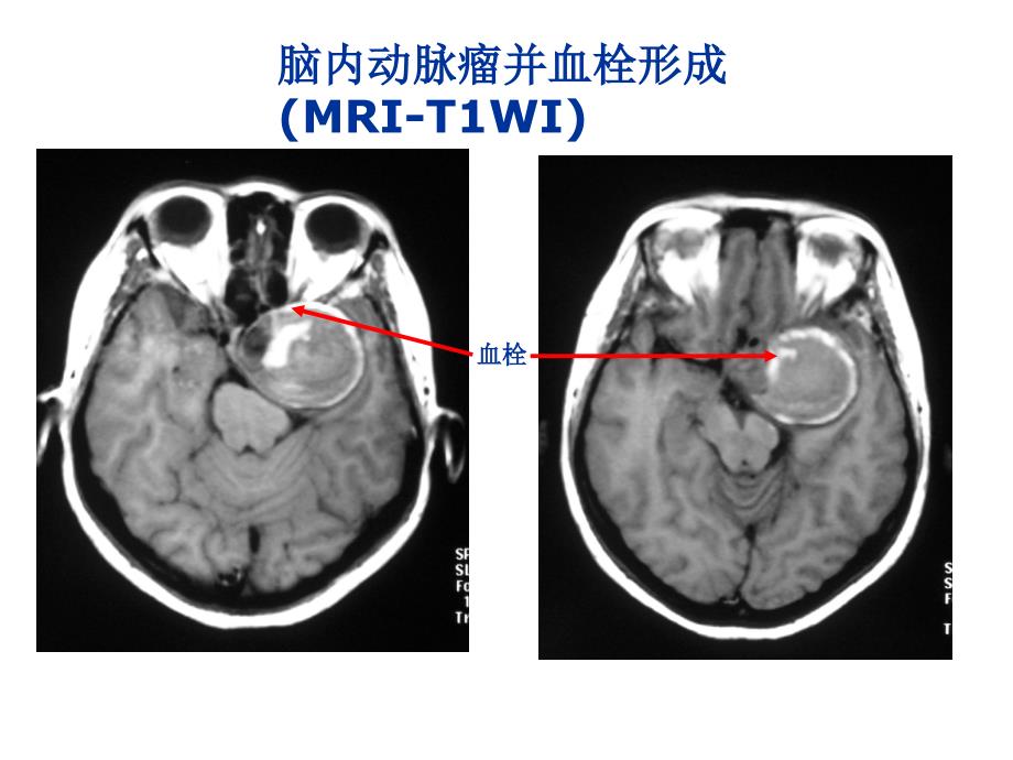 湘雅颅脑应用解剖6_第3页