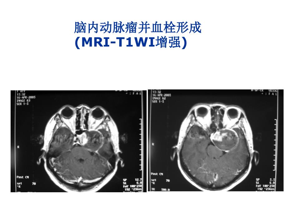 湘雅颅脑应用解剖6_第4页