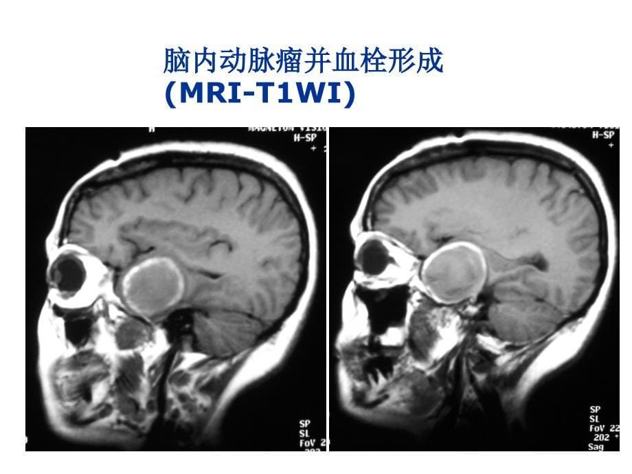 湘雅颅脑应用解剖6_第5页