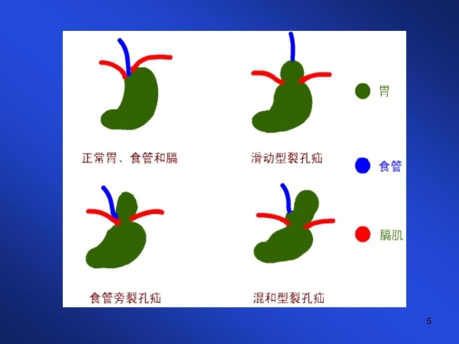 食管裂孔疝PPT课件_第5页