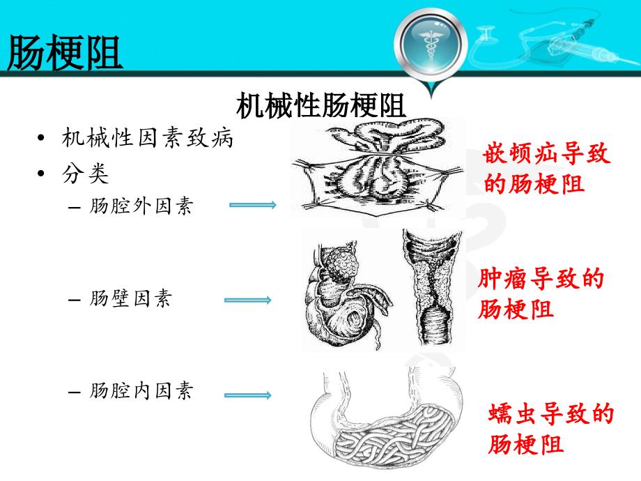 外科学肠梗阻_第4页