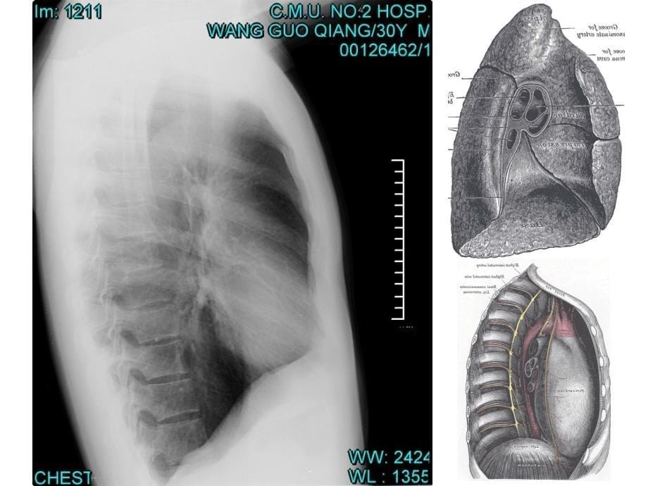 《胸部影像阅读基础》PPT课件讲课教案_第5页