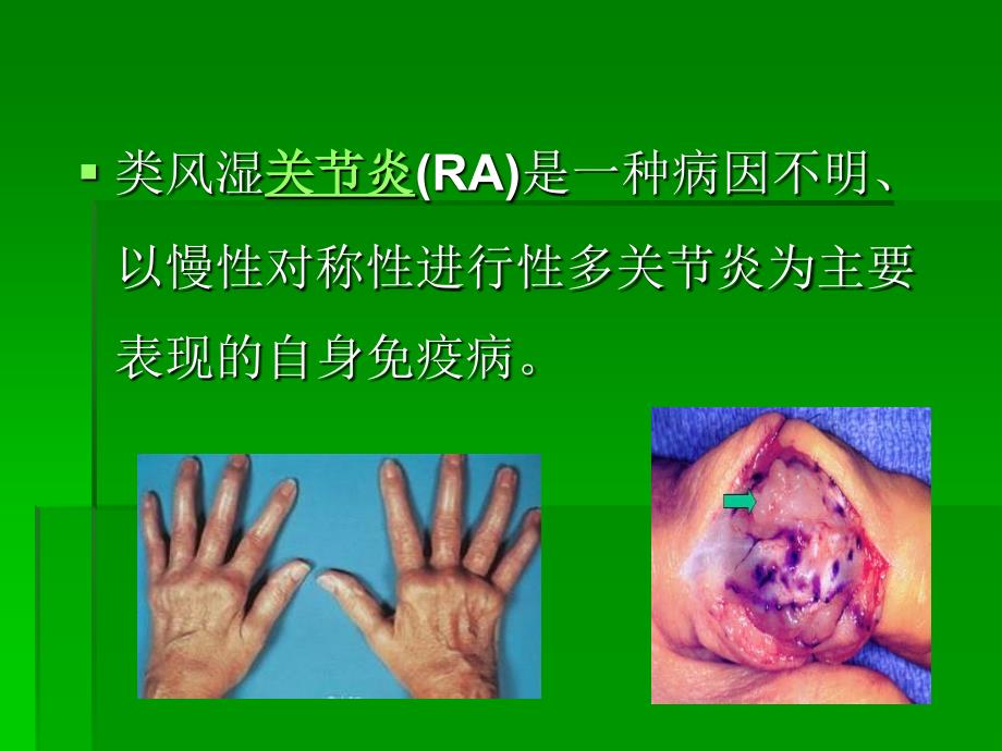 今非昔比类风湿关节炎诊断与治疗的变迁_第4页