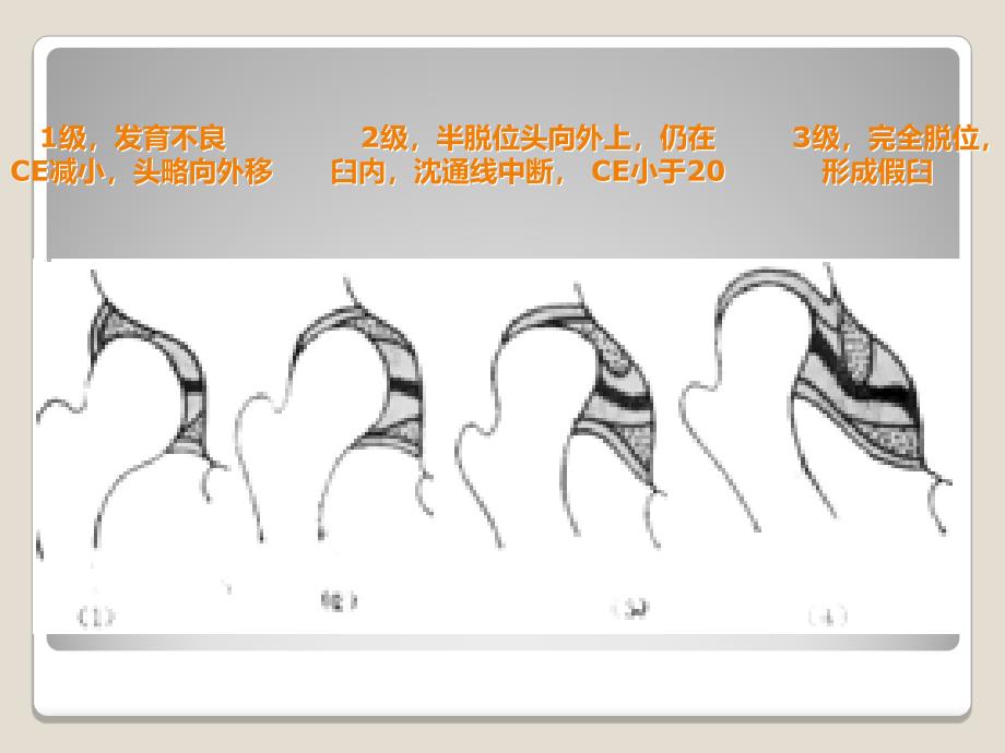 发育性髋关节异常影像学表现_第4页