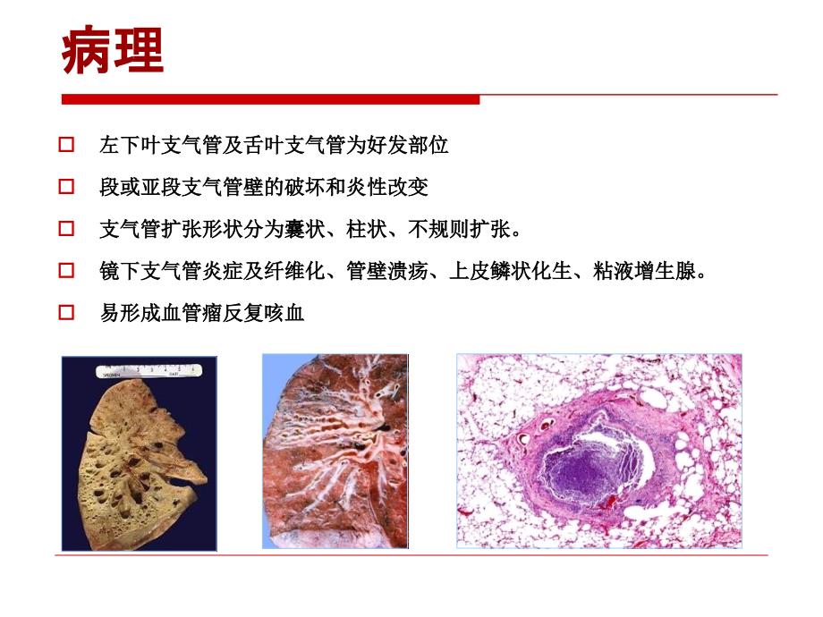 支气管扩张兰瑛_第4页